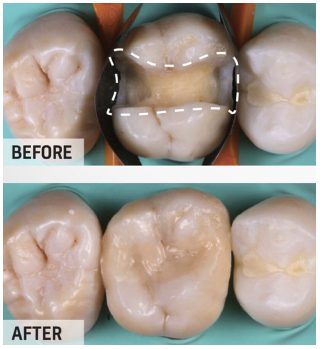Xi măng trám răng🌱GIC Riva Self Cure SDI GIÁ TỐT🌱NHA KHOA MALL🌱